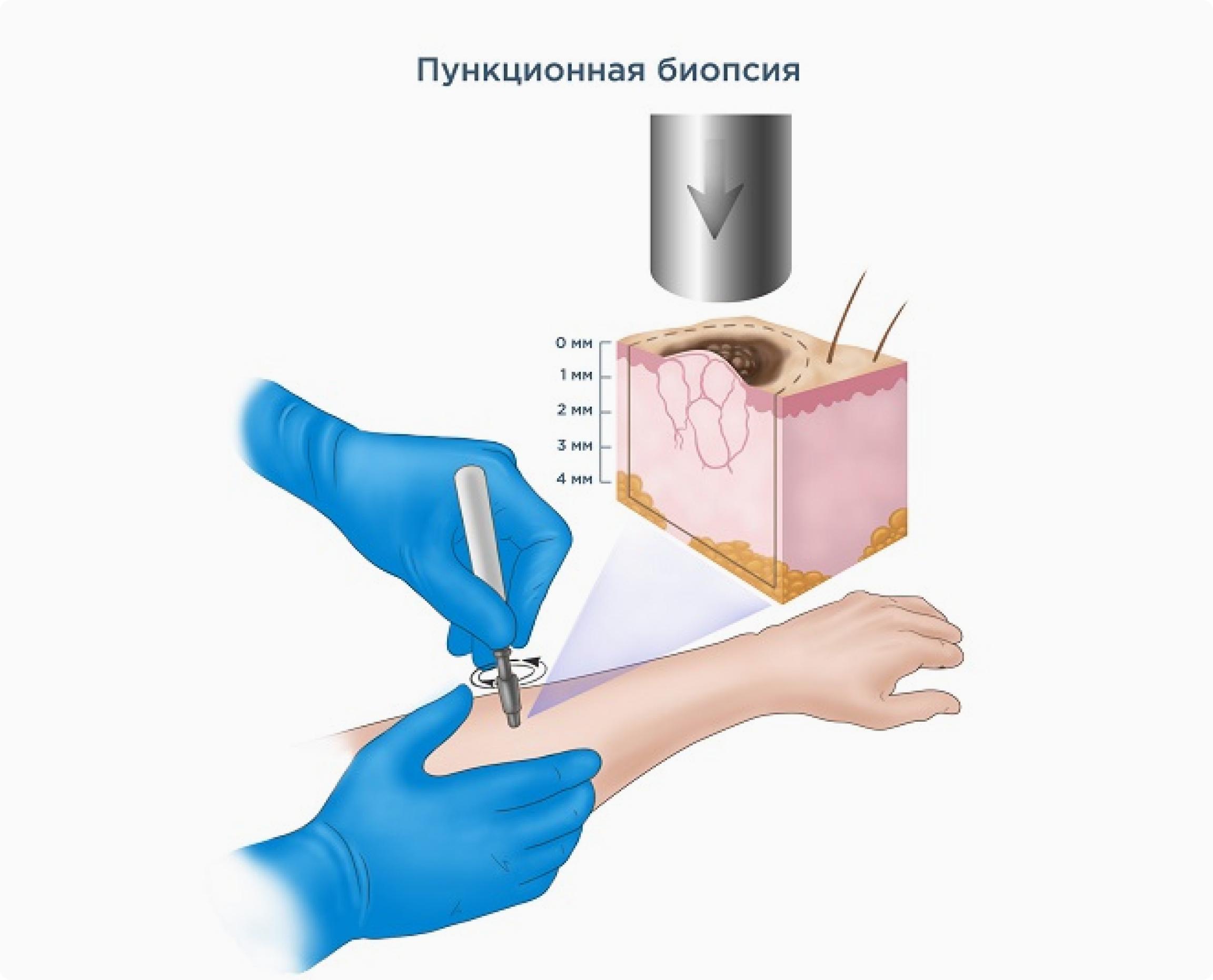 После биопсии